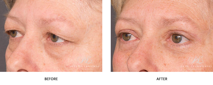 Blepharoplasty before and after, photo 03