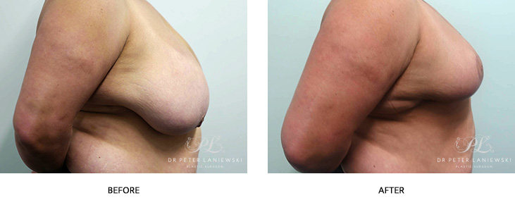 breast reduction before and after images - patient 03 - side view