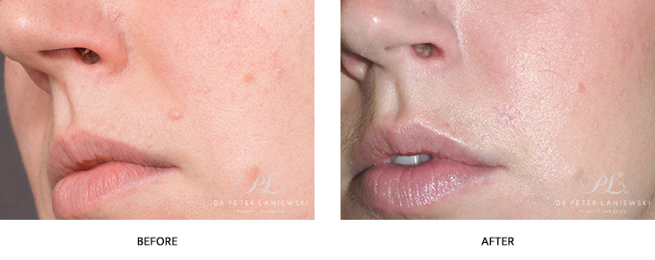 facial mole removal - before and after image - image 01 - side view