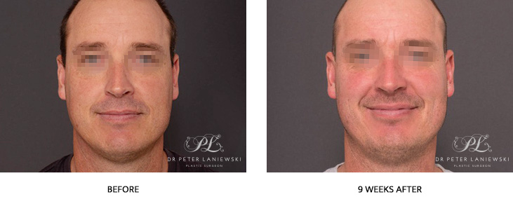 photodynamic therapy patient, pdt therapy photos, before and after 01