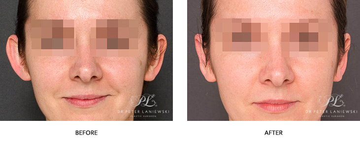 Otoplasty before and after photos 02