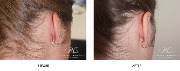 Keloid scar removal from ear, before and after photo 01, side view