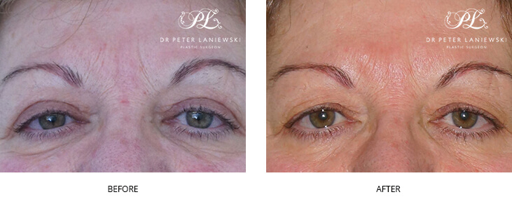 eyelid surgery - before and after gallery - image 001
