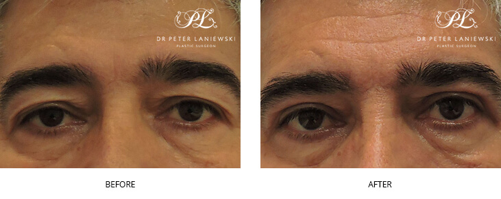 Eyelid surgery before and after, photo 03, blepharoplasty, male patient