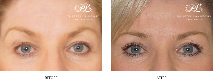 A patient before & after eyelid surgery, photo 04, front view