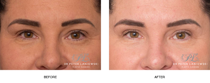 Eyelid surgery before and after, photo 12, front view, female patient