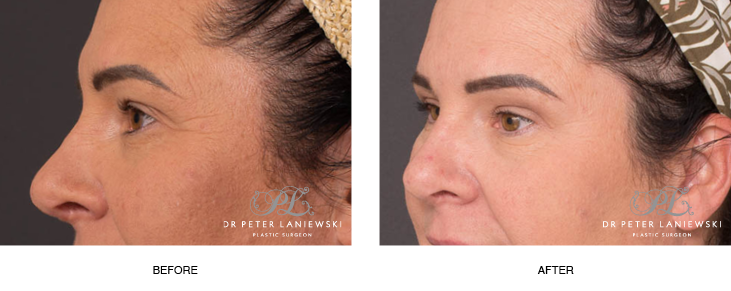 Before and after blepharoplasty, photo 03, side view, female patient