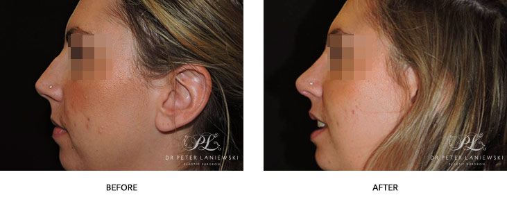 Rhinoplasty before and after gallery, nose job surgery, real patient, side view