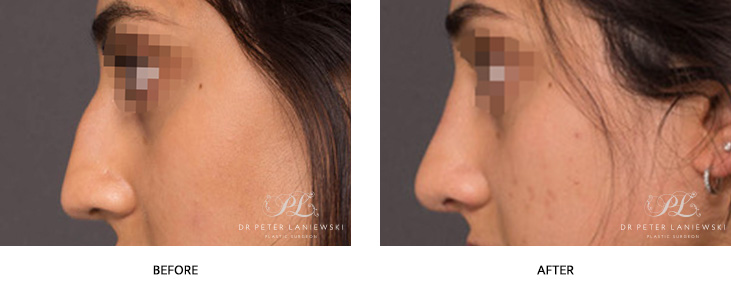 Rhinoplasty before and after, patient 3, photo 02, side view