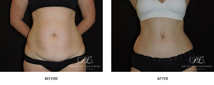Sydney yummy tuck patient before and after 06, Dr Laniewski, front view