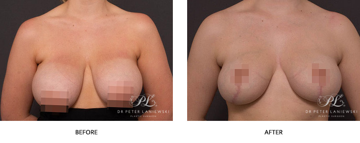 Breast reduction before and after, image 10-01, front view