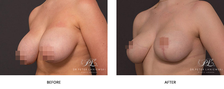 Patient 10-02 before and after breast reduction surgery