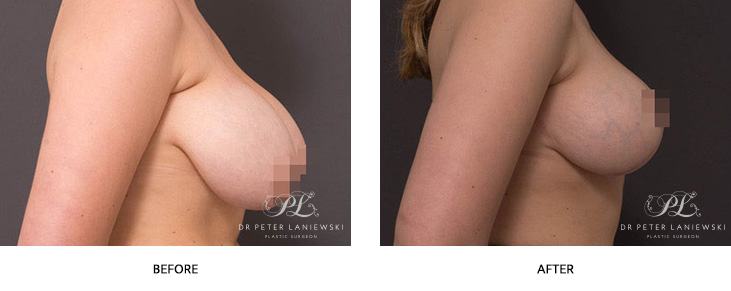 Breast reduction surgery patient before and after, image 10-03, side view
