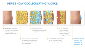 How CoolSculpting Works preview 300x173 1