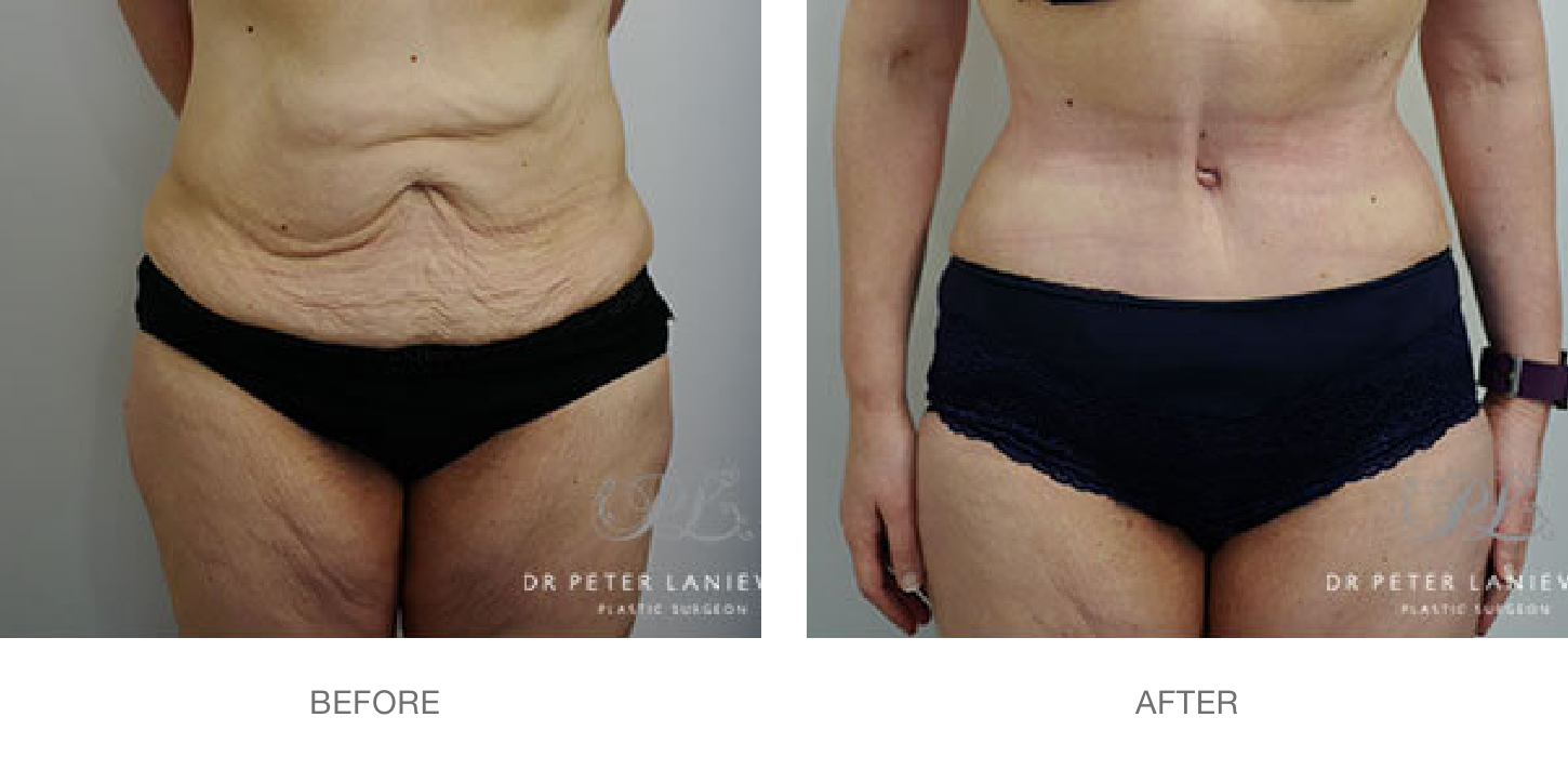 Post-pregnancy body contouring surgery, before and after 01 2x